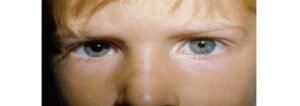 Pupilas e anisocoria